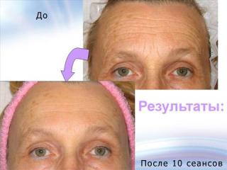 Радиолифтинг RF- лифтинг (термаж).